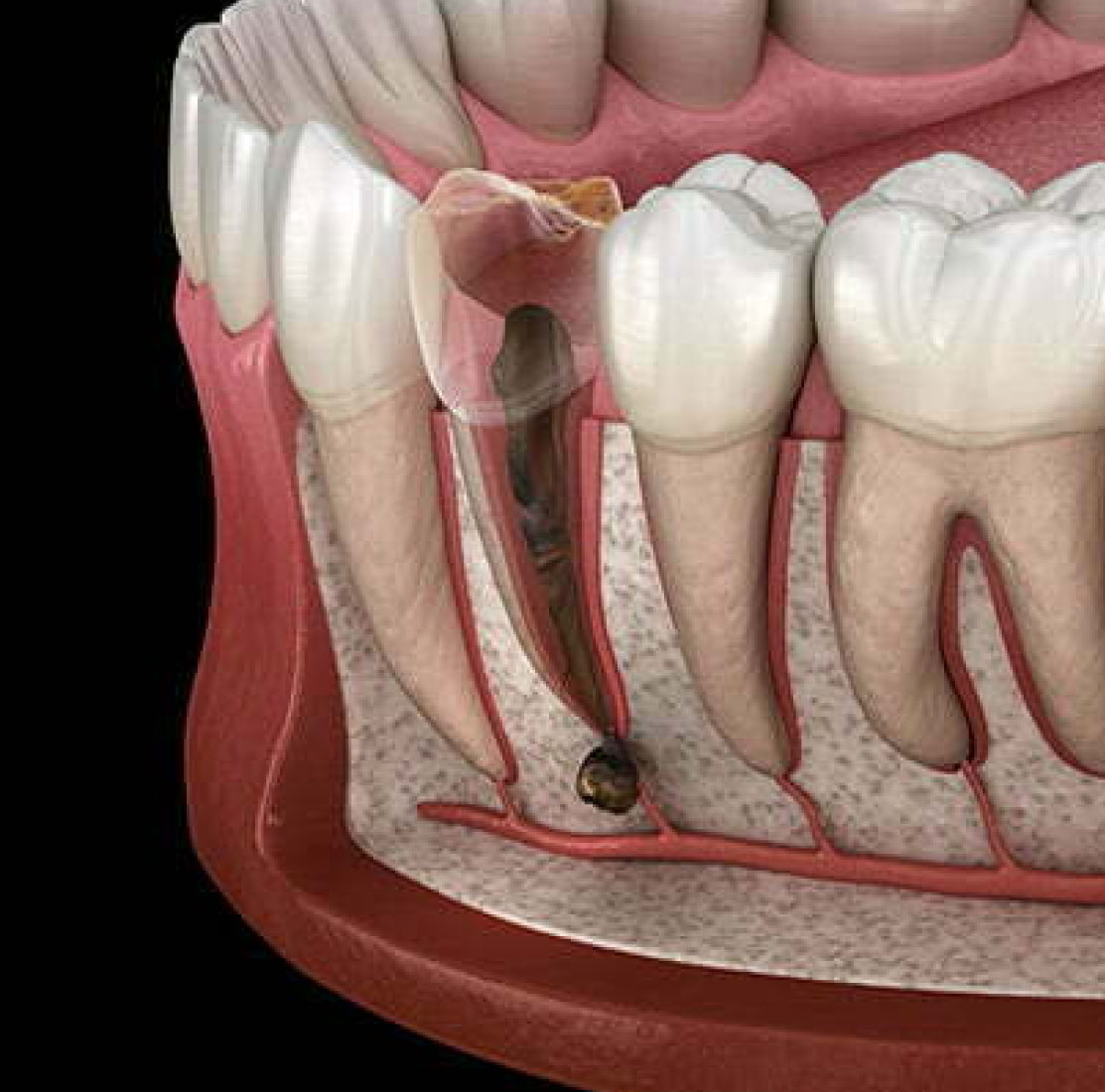 Ulteriori Applicazioni della Terapia Endodontica